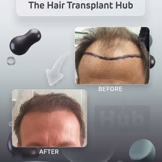 Procedure : Fue hairtransplant 6 months post

Grafts : 3000

1 day procedure 

#beforeandafter #hair