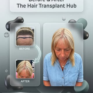 Procedure : Fue hairtransplant 12 months post

Grafts : 2000

1 day procedure 

#beforeandafter #hai