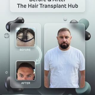 Procedure : Fue hairtransplant 6 months post

Grafts : 2800

1 day procedure 

#beforeandafter #hair