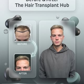 Procedure : Fue hairtransplant 6 months post

Grafts : 3000

1 day procedure 

#beforeandafter #hair