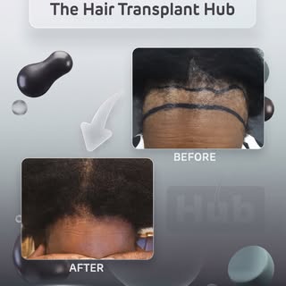 Procedure : Fue hairtransplant 12 months post

Grafts : 2400

1 day procedure 

#beforeandafter #hai