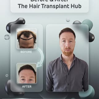 Procedure : Fue hairtransplant 8 months post

Grafts : 3000

1 day procedure 

#beforeandafter #hair
