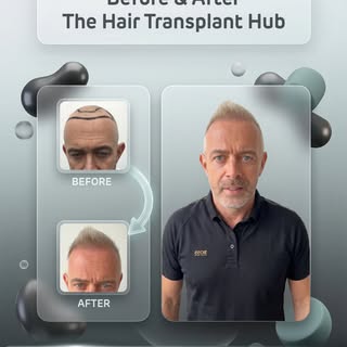 Procedure : Fue hairtransplant 4 months post

Grafts : 2950

1 day procedure 

#beforeandafter #hair