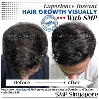 Experience the 𝟏𝟎𝟎% 𝐄𝐟𝐟𝐞𝐜𝐭𝐢𝐯𝐞 𝐇𝐚𝐢𝐫 𝐋𝐨𝐬𝐬 𝐒𝐨𝐥𝐮𝐭𝐢𝐨𝐧 𝐰𝐢𝐭𝐡 𝐈𝐦𝐦𝐞𝐝𝐢𝐚