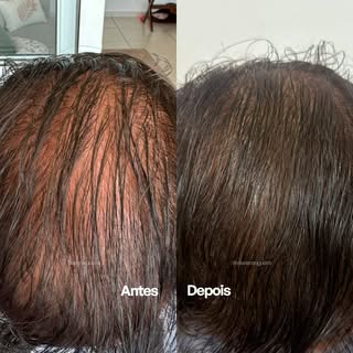 Esse resultado não foi do dia pra noite.
E também não foi sorte.

Foram 3 meses de tratamento em cas