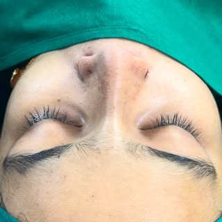 Rhinoplasty transformation for flat and broad nose in India 🇮🇳 #broadnosecorrection #flatnose #big