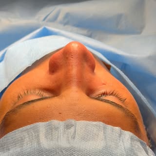 Best Crooked nose correction in In India 🇮🇳🇮🇳🇮🇳 #deviatednose #deviatednasalseptum #crookednos
