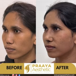 It’s always difficult to reconstruct a hypoplastic nose with underdeveloped maxilla. This the best p