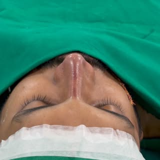 Thick skin rhinoplasty transformation in India 🇮🇳🇮🇳🇮🇳 #nosereshaping #noseslimming #noserecons