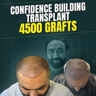 “थोडा डर था…. पर अब बहोत खुश हू” 

4500 grafts. One decision. Life-changing confidence.

This is a r