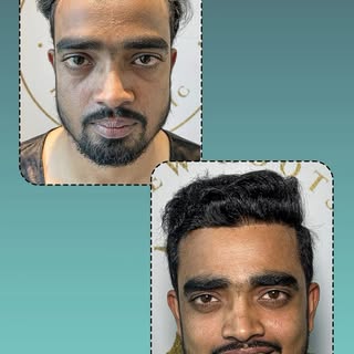 Grade 3 Baldness → Natural Hairline Restoration 💯

From visible hair loss to a fuller, natural-look