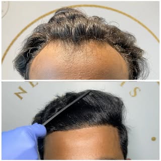 Zoom in. No filters. Just a natural hairline with real density. 🔥
 Because the best hair transplant