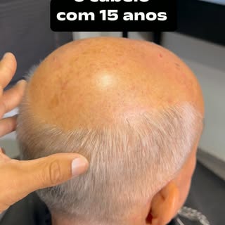 Aos 15 anos já começou a perder os cabelos, isso está cada dia mais comum nos dias de hoje !!! 😱😱�