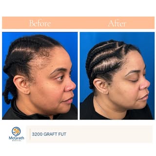 Our patient came to us seeking a solution for hair loss, and look at the stunning difference now! 👏