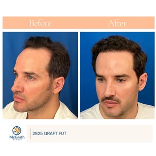 Confidence restored, hairline transformed✨ #hairrestoration #hairtransformation #hairtransplant #tra