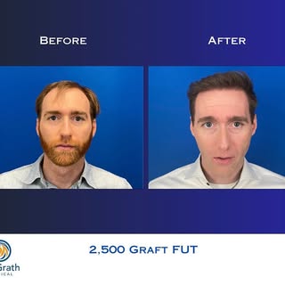 Another amazing transformation 🤩 #hairtransformation #hairtransplant #transplantecapilar