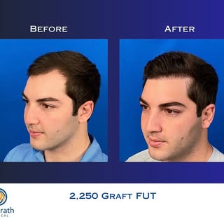 One year hair transformation 🤩 #hairtransplant #austinhairtransplantsurgeon #texas #texashairtransp