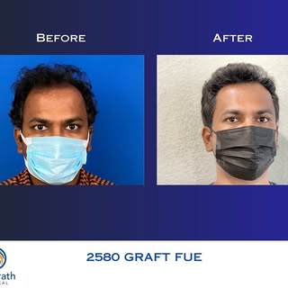 Another transformation ✨#hairtransformation #hairtransplant #transplantecapilar