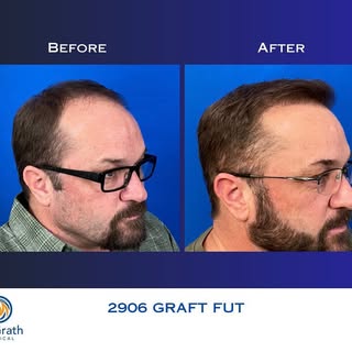#hairtransformation #hairtransplant #transplantecapilar #austin