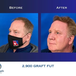 ✨✨✨✨ #hairtransformation #hairtransplant #transplantecapilar #fut #transplants