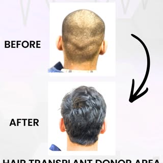 Wondering How the Back of Your Head Looks After a Hair Transplant?✨
Hair transplant donor area looki