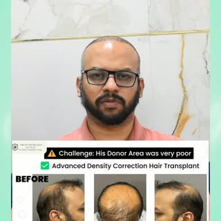 Turkey Nahi... Noida Ne Badal Di Meri Life! 💯
😲 Hair Transplant ke baad pehle 7 din kaise hote hai