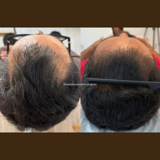 @isabelamaraltricologista 

Sair do “zero” pro cabelo cheio envolve:
✅ Paciência: O cabelo tem seu p