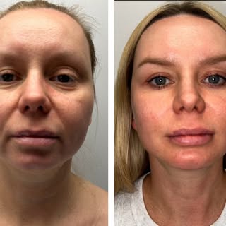 ✨BEFORE AND AFTER✨ 

In Dr. Patel’s expert hands, his procedures work to tighten sagging skin, smoot
