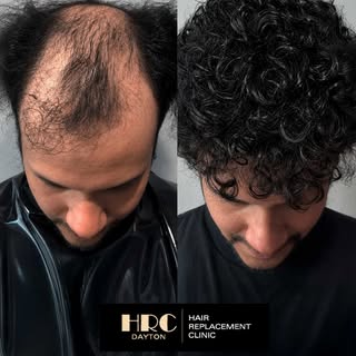 A New Look. A New Level of Confidence. 

Hair loss doesn't have to define you.

With CRLAB CNC Men's