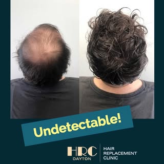 Before & After 🙌 Non surgical hair replacement with CRLAB CNC exclusively at HRC Dayton.
Tired of d