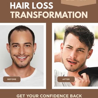 Experience a tailored approach to hair restoration with CRLAB hair replacement systems for men, desi