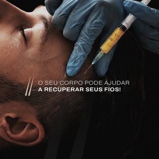A Lipoenxertia Capilar é uma das técnicas mais modernas da medicina regenerativa. Em vez de substânc