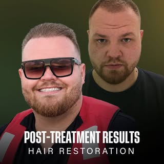 Confidence starts with the right approach. 

A real hair restoration journey, carefully planned to a
