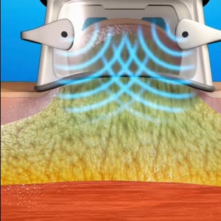 ❄️ Freeze the fat, not your confidence! 💙

Ever wondered how  Cryolipolysis works? This advanced, n