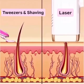 Say goodbye to unwanted hair and hello to smooth, confident skin! ✨

Laser Hair Removal offers a saf