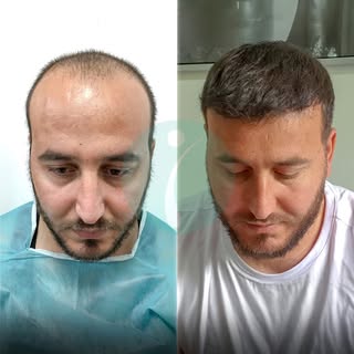 The most important result of a hair transplant isn’t just growth — it’s how natural it looks. ✨
⁠
At