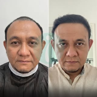 A new hairline. A new confidence. A whole new look 🔥

This transformation is proof that the right t