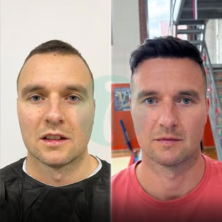 From M-Shaped Hairline to Full Hair Again

A stronger hairline.
A younger look.
A new confidence. 

