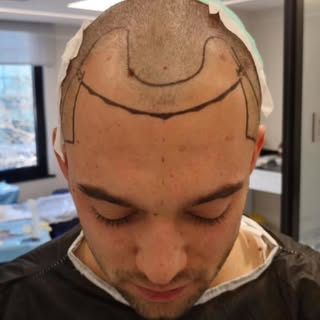 Tap to see this incredible journey from Day 0 to Month 7 after a hair transplant at Ilyas Arslan Hai