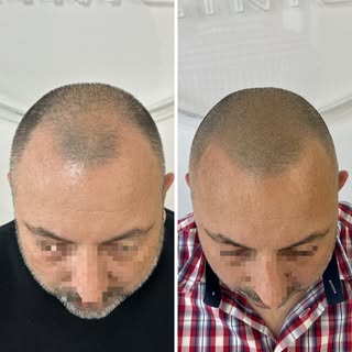 Razlika koja menja sve: Pre i mesec dana nakon završetka procesa. 

Desna slika prikazuje potpuno za