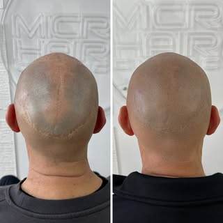 Umetnost SMP-a: 3 sesije, healed rezultat. 🔥
Ovaj klijent je trpeo posledice tri stare FUT transpla