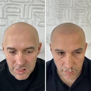 Najbolja mikropigmentacija vlasišta je ona za koju niko ne zna da je urađena. 
Poenta ovog tretmana 