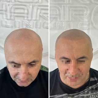 Čelna linija, ki naredi ključno razliko. 🔥

Okvir obraza je vse. Ko lasje izpadejo, obraz izgubi sv