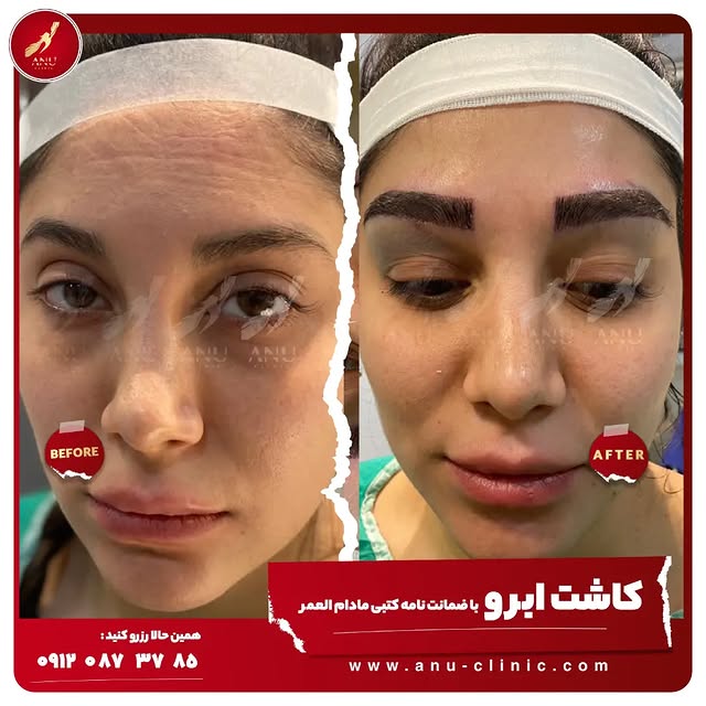 .
❤کاشت ابرو ی بی نظیر از کلینیک آنو ..👰‍♀️😍
.
| #پرپشت_فکر_کنید |
.
همین حالا رزرو کنید :
وبسایت 