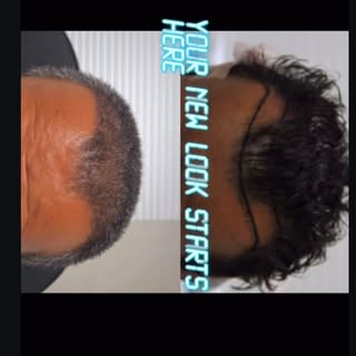 Get your hair back at FUE hair of Texas 😉#fuehairtransplantation #goodbyehairloss #getyourconfidenc
