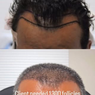 #fuehairtransplantation #goodbyehairloss #getyourconfidenceback #stemcelltherapy #naturalhair #thinn