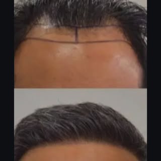 #fuehairtransplantation #hairoftexas #goodbyehairloss #getyourconfidenceback #thinninghairsolutions 