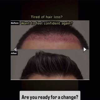 #hairgoals #hairtransformation #fuehairtransplant #getyourconfidenceback #stemcelltherapy #thinningh