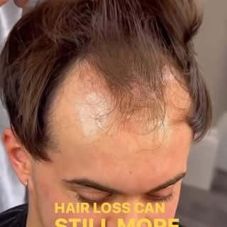 #goodbyehairloss #getyourconfidenceback #stemcelltherapy #fuehairtransplantation #naturalhair #nonsu