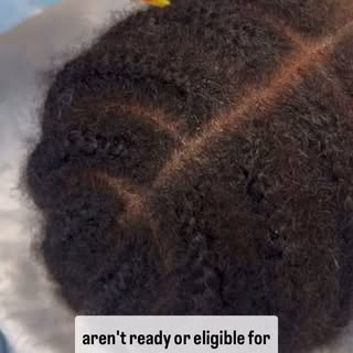 #stemcelltherapy #thinninghairsolutions #getyourconfidenceback #naturalhair #fuehairtransplantation 